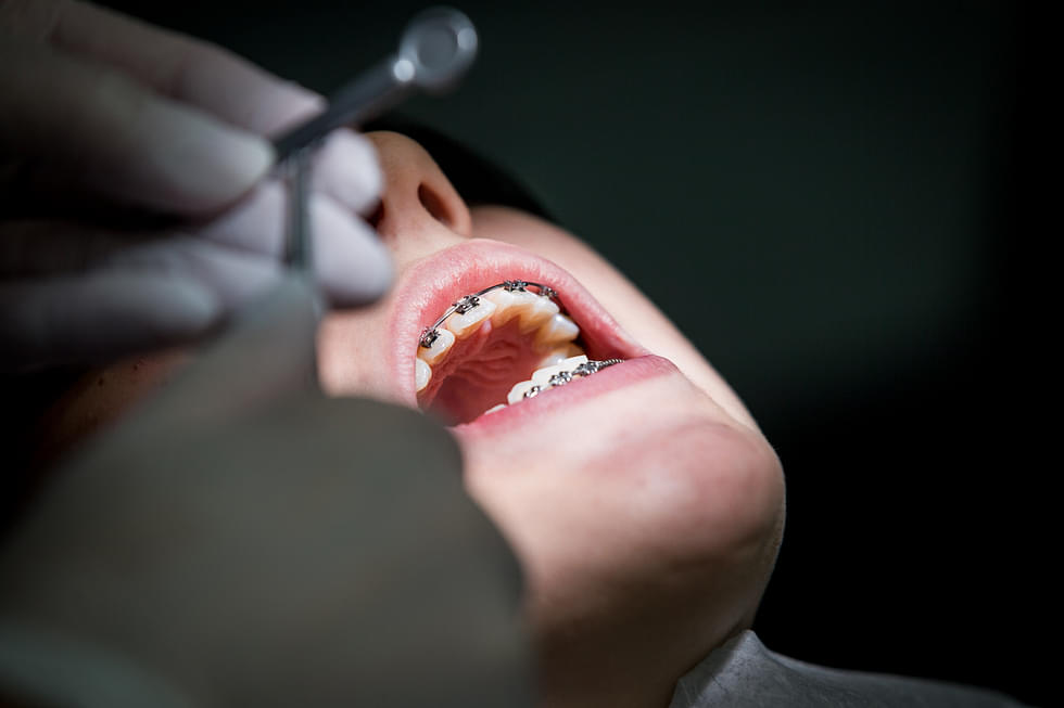 Purentavirheet kannattaa ensisijaisesti hoitaa lapsena tai nuorena. Aikuisten hampaita oiotaan useimmiten yksityisellä puolella.